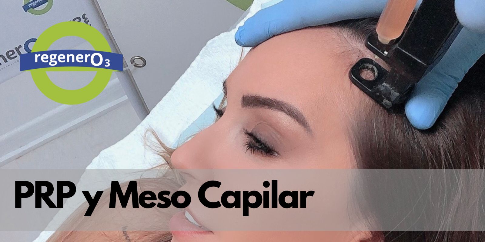 PRP y Mesoterapia en la caída del cabello